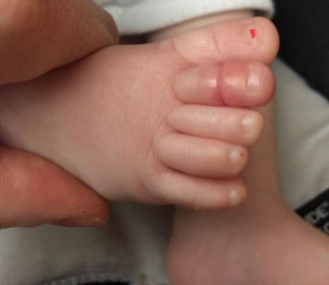 Le syndrome du tourniquet : un bébé a failli perdre un orteil à cause d&rsquo;un cheveu