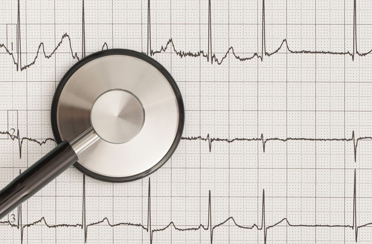 ECG montre connectée
